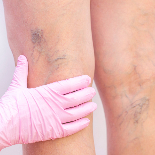 Vascular Surgery